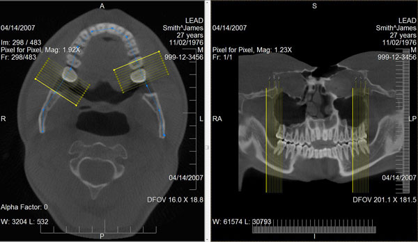 curved mpr / panoramic screenshot